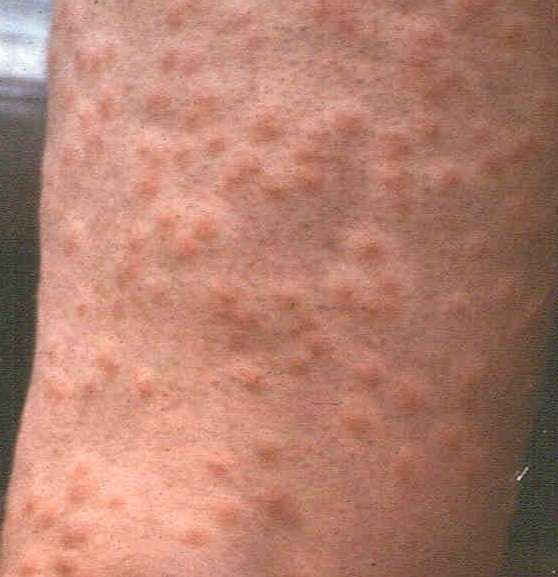 swimmers itch images