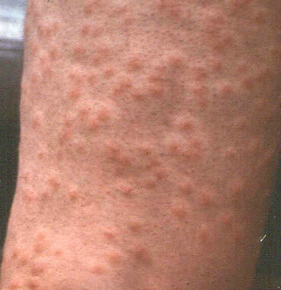 allergic reaction swimmers itch rash